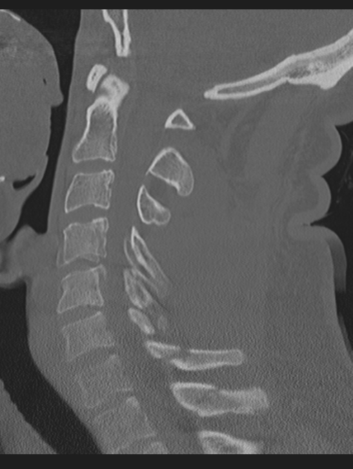 Cavernoma of cervical cord (Radiopaedia 50838-56346 Sagittal bone window 42).png
