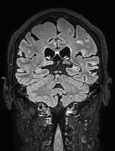 Cavernous hemangioma of the cerebellar falx (Radiopaedia 73025-83724 Coronal FLAIR 223).jpg