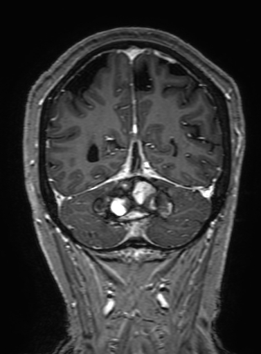 Cavernous hemangioma of the cerebellar falx (Radiopaedia 73025-83724 Coronal T1 C+ 292).jpg