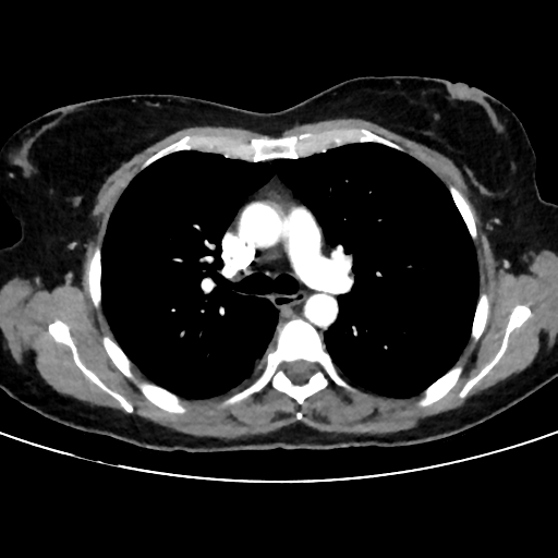 File:Cavitating lung mass - squamous cell carcinoma (Radiopaedia 48047-52854 B 20).png