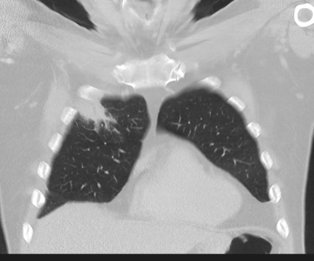File:Cavitating pneumonia (Radiopaedia 45998-50329 Coronal lung window 13).png