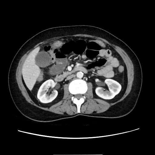 Cecal adenocarcinoma (Radiopaedia 75909-87331 A 41).jpg