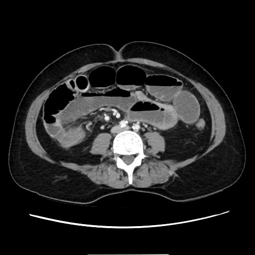 Cecal adenocarcinoma (Radiopaedia 75909-87331 A 53).jpg