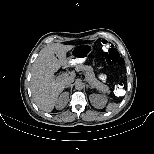 Cecal adenocarcinoma (Radiopaedia 85324-100916 Axial non-contrast 23).jpg