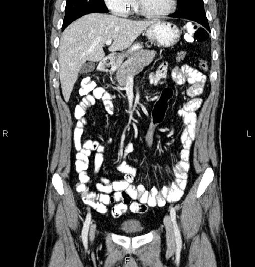Cecal adenocarcinoma (Radiopaedia 85324-100916 D 21).jpg