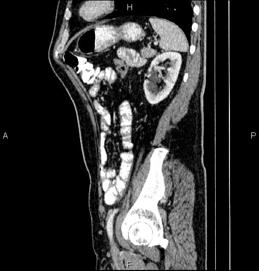 Cecal adenocarcinoma (Radiopaedia 85324-100916 E 70).jpg