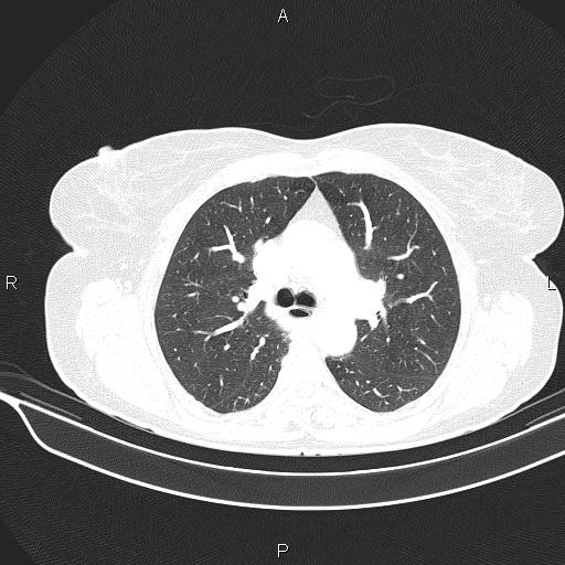Cecal cancer (Radiopaedia 85610-101358 Axial lung window 25).jpg