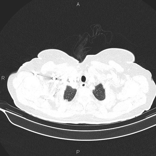 Cecal cancer (Radiopaedia 85610-101358 Axial lung window 7).jpg