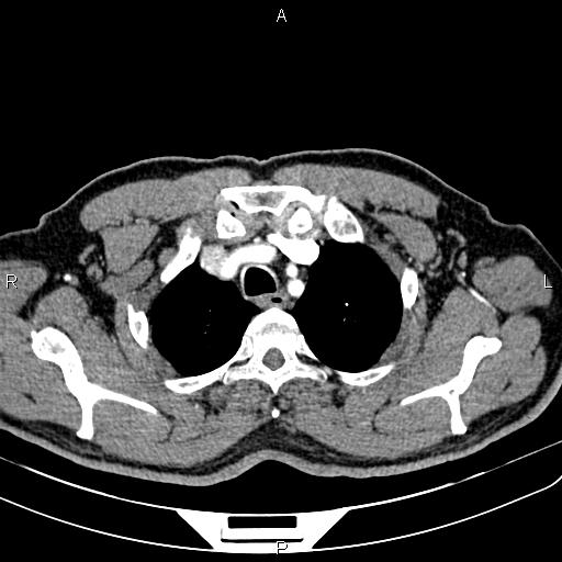 File:Cecal cancer with appendiceal mucocele (Radiopaedia 91080-108651 A 14).jpg