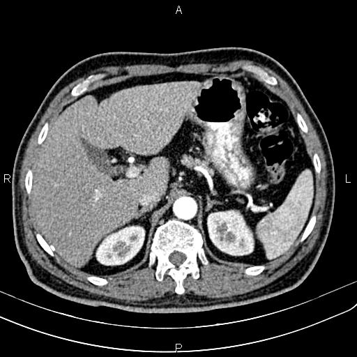 Cecal cancer with appendiceal mucocele (Radiopaedia 91080-108651 A 66).jpg