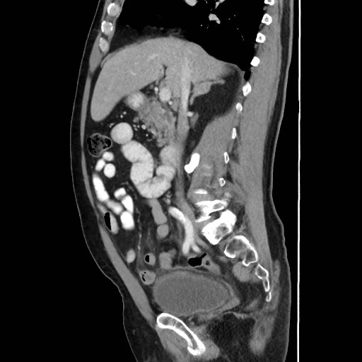 Cecal mass causing appendicitis (Radiopaedia 59207-66531 C 27).jpg