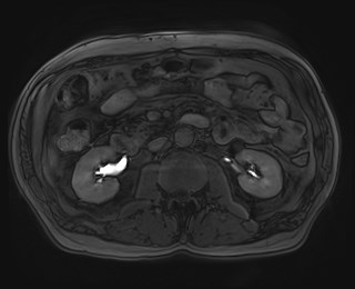 Cecal mass causing appendicitis (Radiopaedia 59207-66532 K 63).jpg