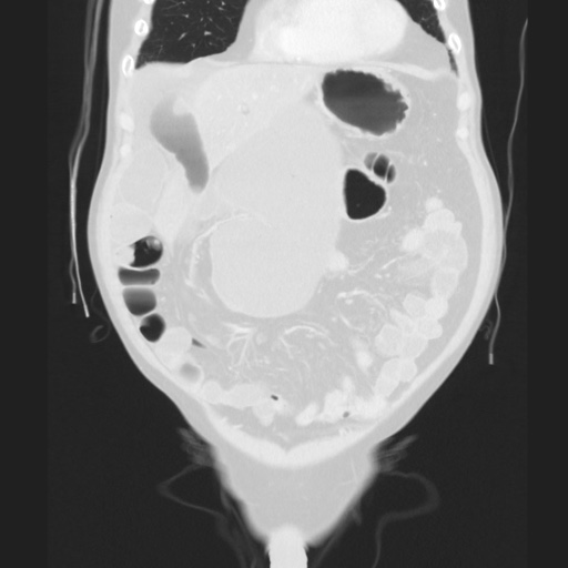 Cecal volvulus (Radiopaedia 75378-86620 Coronal lung window 49).jpg