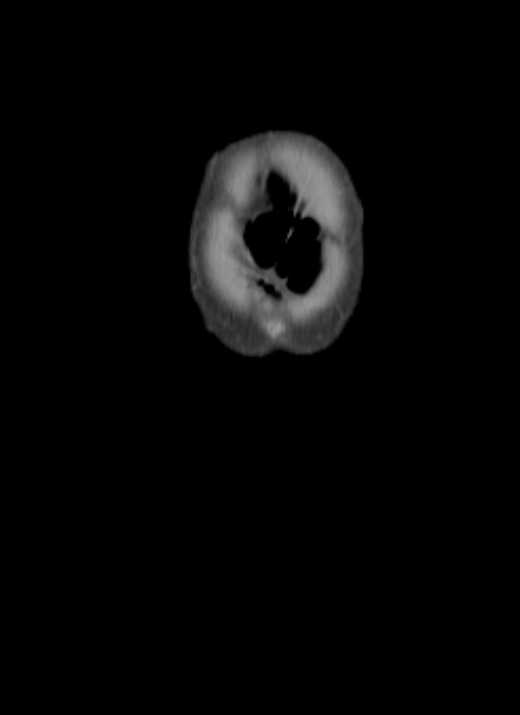 Cecal volvulus with pneumatosis coli (Radiopaedia 68572-78178 B 76).jpg