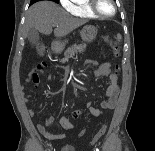Celiac artery dissection (Radiopaedia 52194-58080 C 9).jpg