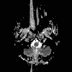 File:Central-variant posterior reversible encephalopathy syndrome (PRES) (Radiopaedia 43880-47358 Axial ADC 1).jpg