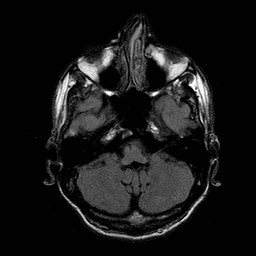 File:Central-variant posterior reversible encephalopathy syndrome (PRES) (Radiopaedia 43880-47359 Axial FLAIR 4).jpg
