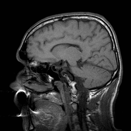 File:Central-variant posterior reversible encephalopathy syndrome (PRES) (Radiopaedia 43880-47359 Sagittal T1 14).jpg