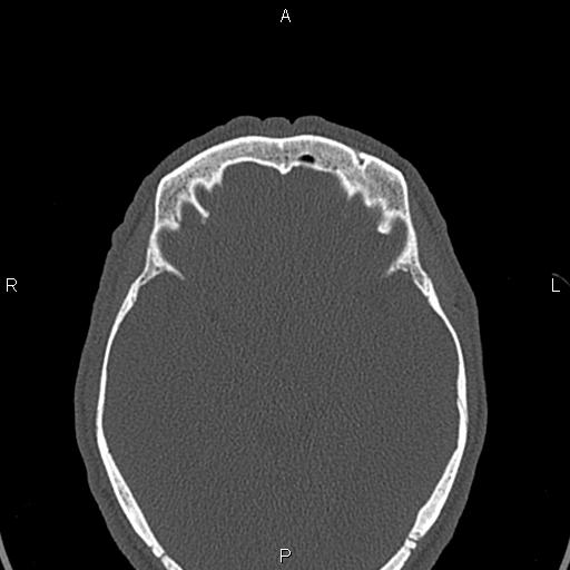 File:Central giant cell granuloma (Radiopaedia 83346-97761 Axial bone window 72).jpg