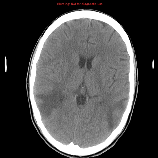 File:Central nervous system vasculitis (Radiopaedia 8410-9234 Axial non-contrast 14).jpg