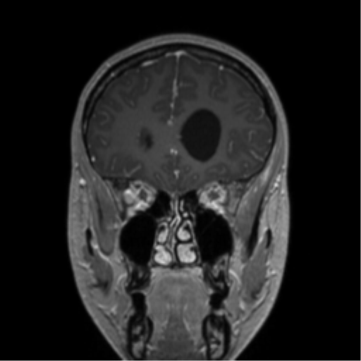 Central neurocytoma (Radiopaedia 37664-39557 Coronal T1 C+ 65).png