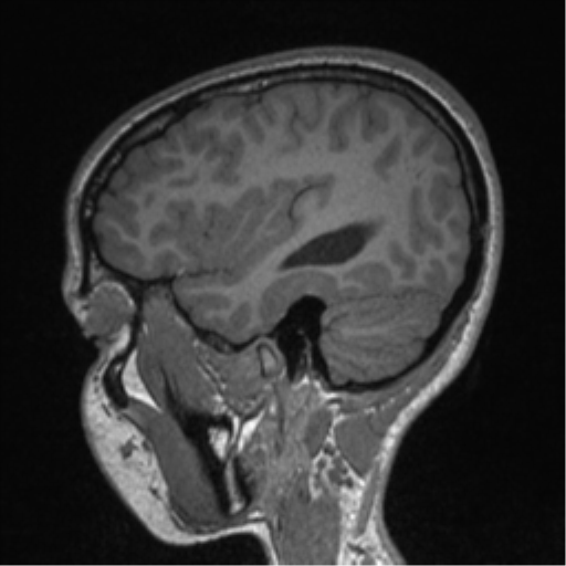 Central neurocytoma (Radiopaedia 37664-39557 Sagittal T1 25).png