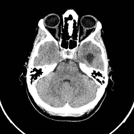 Central neurocytoma (Radiopaedia 84497-99871 Axial non-contrast 11).jpg