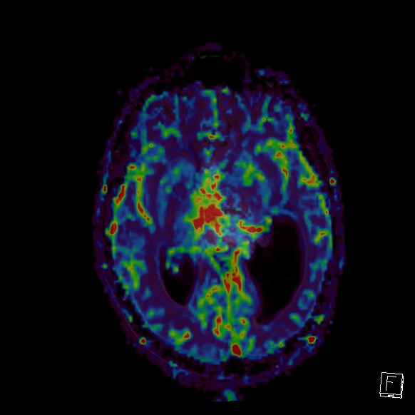 Central neurocytoma (Radiopaedia 84497-99872 Axial Perfusion 169).jpg