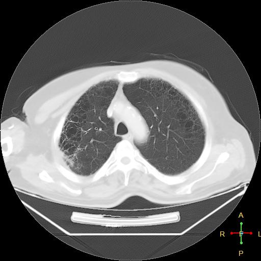 File:Centrilobular emphysema - with superimposed infection (Radiopaedia 24389-24683 lung window 8).jpg