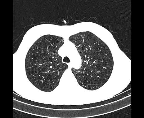 Centrilobular pulmonary emphysema (Radiopaedia 62468-70718 Axial lung window 20).jpg