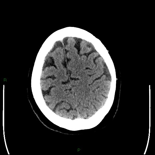 Cerebellar abscess (Radiopaedia 78135-90671 Axial non-contrast 89).jpg