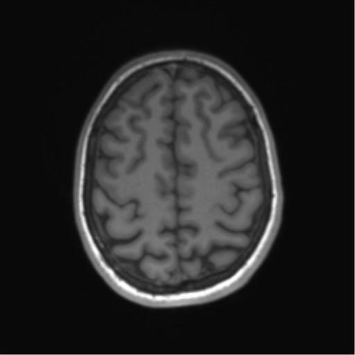 Cerebellar agenesis with hypoplastic pons (pontocerebellar hypoplasia) (Radiopaedia 57224-64138 Axial T1 60).png
