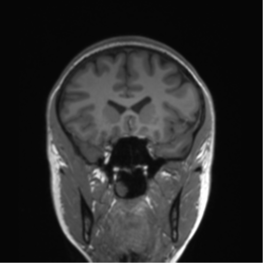 Cerebellar agenesis with hypoplastic pons (pontocerebellar hypoplasia) (Radiopaedia 57224-64138 Coronal T1 63).png