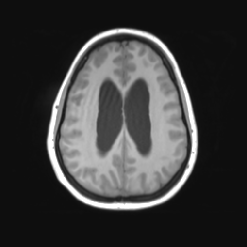 File:Cerebellar ependymoma complicated by post-operative subdural hematoma (Radiopaedia 83322-97736 Axial T1 28).png