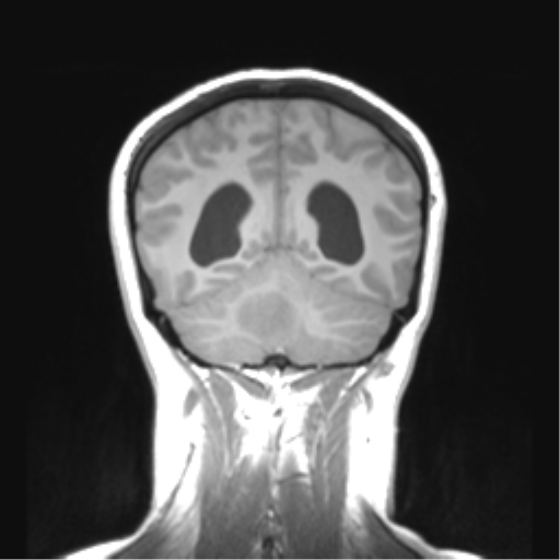 File:Cerebellar ependymoma complicated by post-operative subdural hematoma (Radiopaedia 83322-97736 Coronal T1 43).png