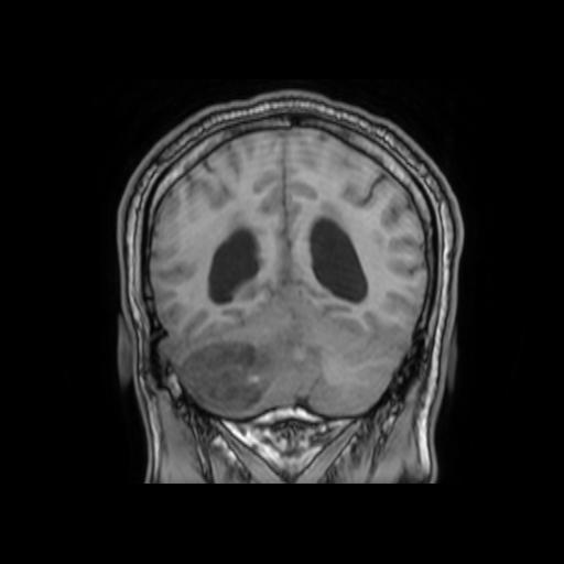File:Cerebellar hemangioblastoma (Radiopaedia 88055-104622 Coronal T1 27).jpg