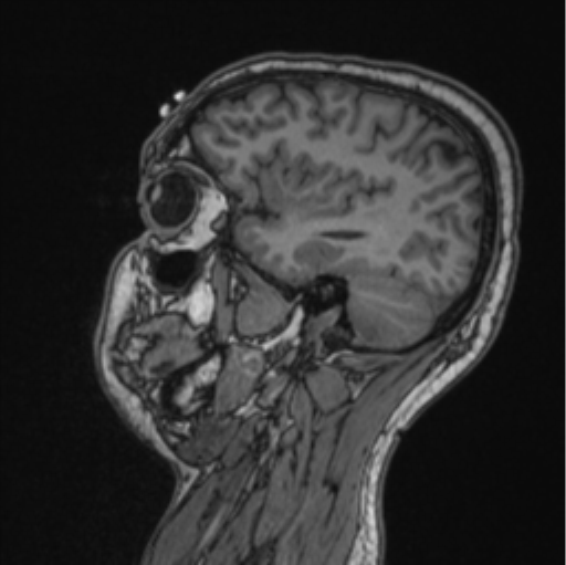 File:Cerebellar hemangioblastomas and pituitary adenoma (Radiopaedia 85490-101176 Sagittal T1 36).png