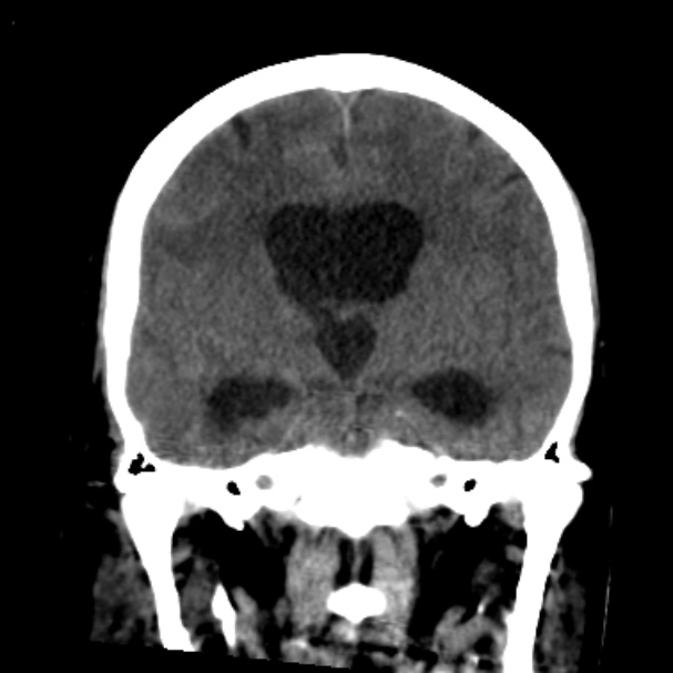 Cerebellar hemorrhage causing obstructive hydrocephalus (Radiopaedia 33989-35207 Coronal non-contrast 27).jpg