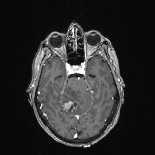 Cerebellar metastases (Radiopaedia 24038-24249 Axial T1 C+ 26).jpg