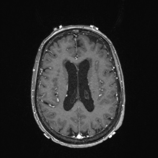 Cerebellar metastases (Radiopaedia 24038-24249 Axial T1 C+ 6).jpg