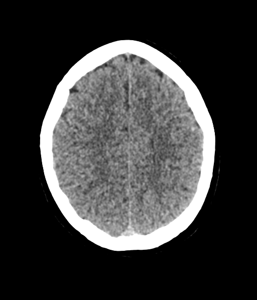 Cerebellar metastases - colorectal adenocarcinoma (Radiopaedia 40947-43652 Axial non-contrast 50).png