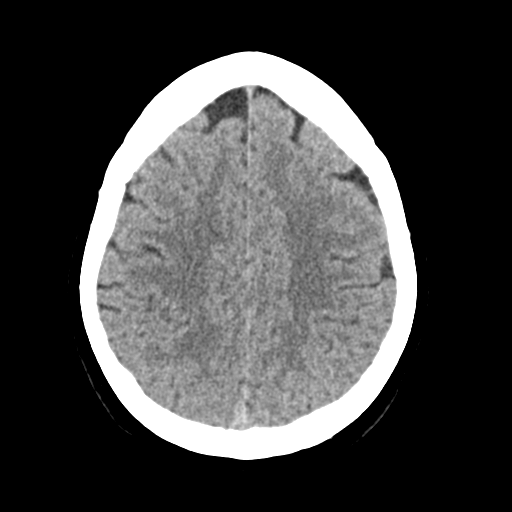 File:Cerebellar metastasis (Radiopaedia 54578-60812 Axial non-contrast 37).png