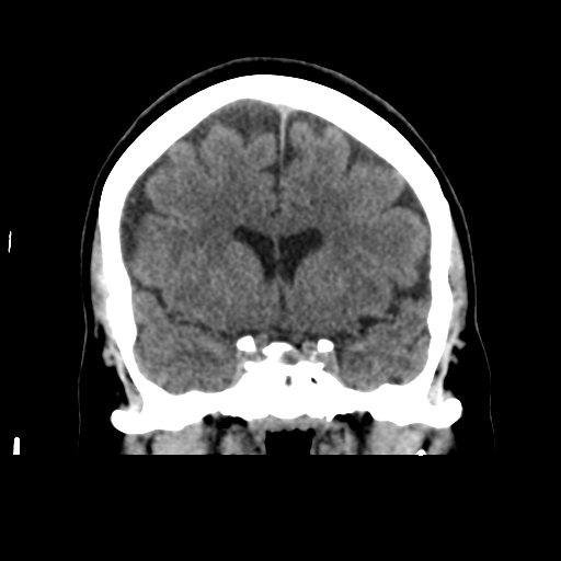 Cerebellar metastasis (cystic appearance) (Radiopaedia 41395-44258 Coronal non-contrast 26).png