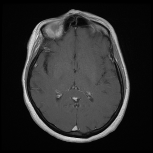 File:Cerebellar metastasis (cystic appearance) (Radiopaedia 41395-44268 Axial T1 C+ 12).png