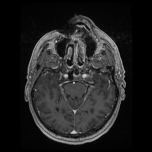 Cerebellar metastasis of pulmonary adenocarcinoma, cavernous venous malformation, and developmental venous anomaly (Radiopaedia 85827-101661 Axial T1 C+ 37).jpg