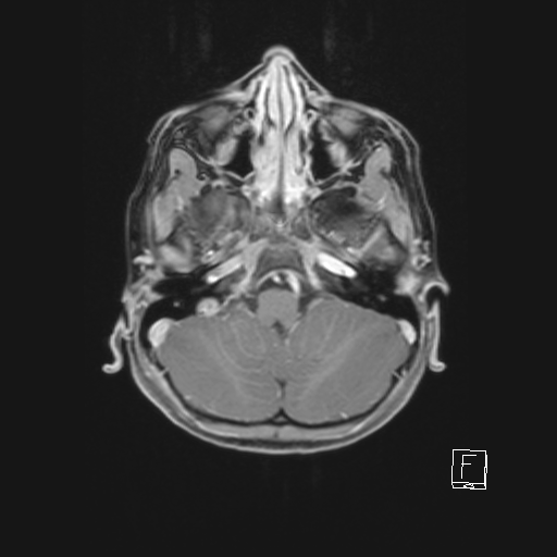 File:Cerebellar stroke (Radiopaedia 32202-33150 Axial T1 C+ 22).png