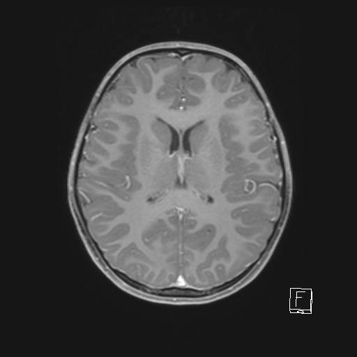 Cerebellar stroke (Radiopaedia 32202-33150 Axial T1 C+ 44).png