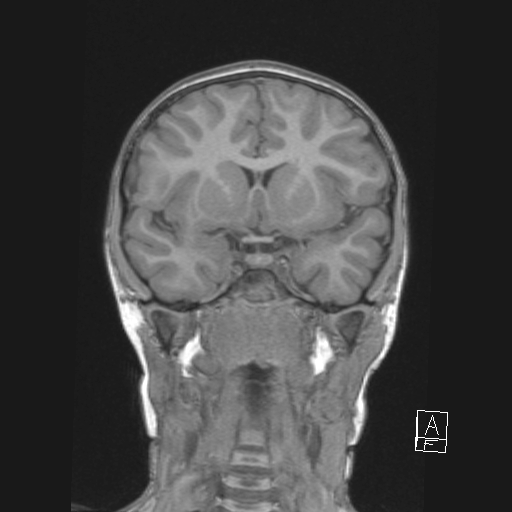 Cerebellar stroke (Radiopaedia 32202-33150 Coronal T1 24).png