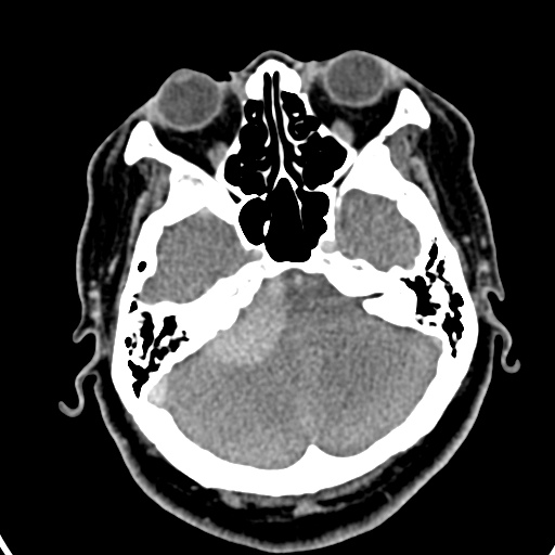 Cerebellopontine angle meningioma (Radiopaedia 35181-36714 A 27).jpg