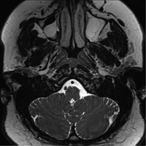 Cerebellopontine angle meningioma (Radiopaedia 48434-53348 Axial T2 Space 24).png